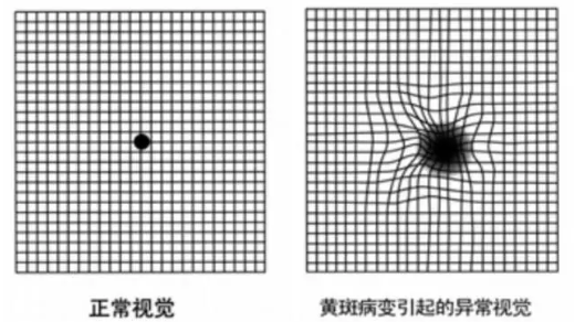 黃斑變性